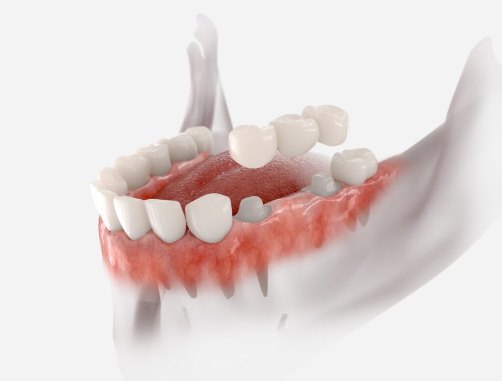 dental bridges dentist in Orlando