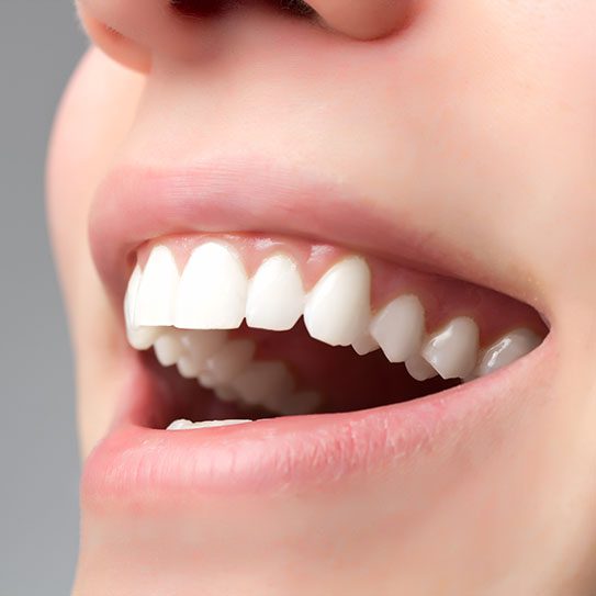 gum depigmentation gum bleaching