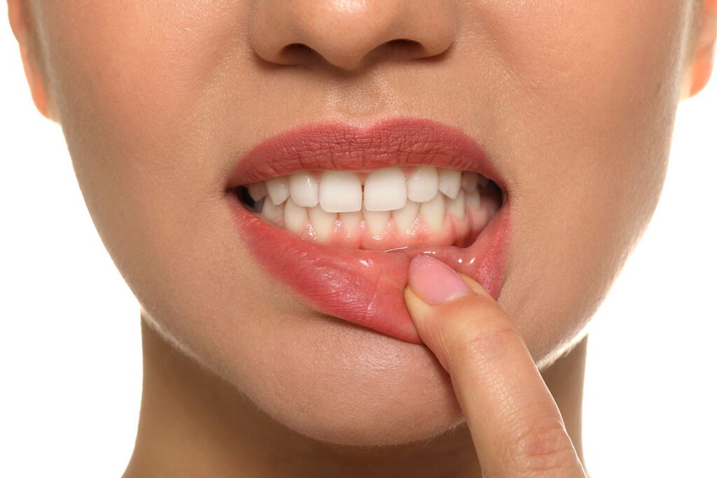 Gum depigmentation gum bleaching