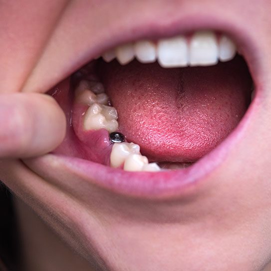 Orlando dental implants