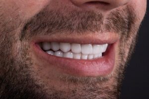 teeth whitening orlando