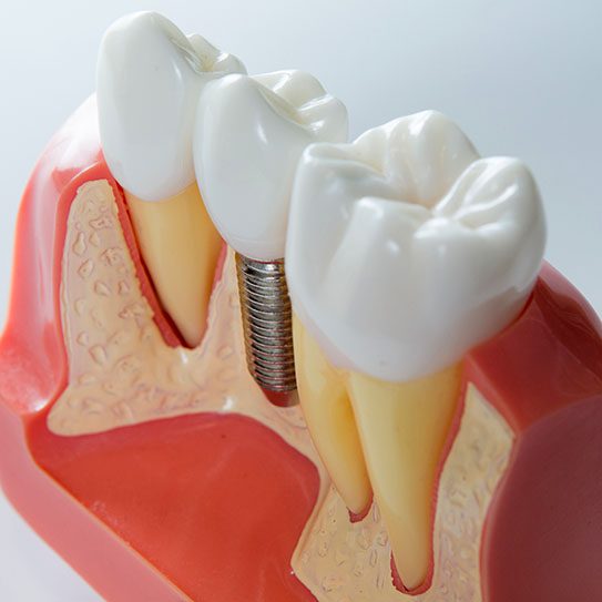 dental implants in Orlando